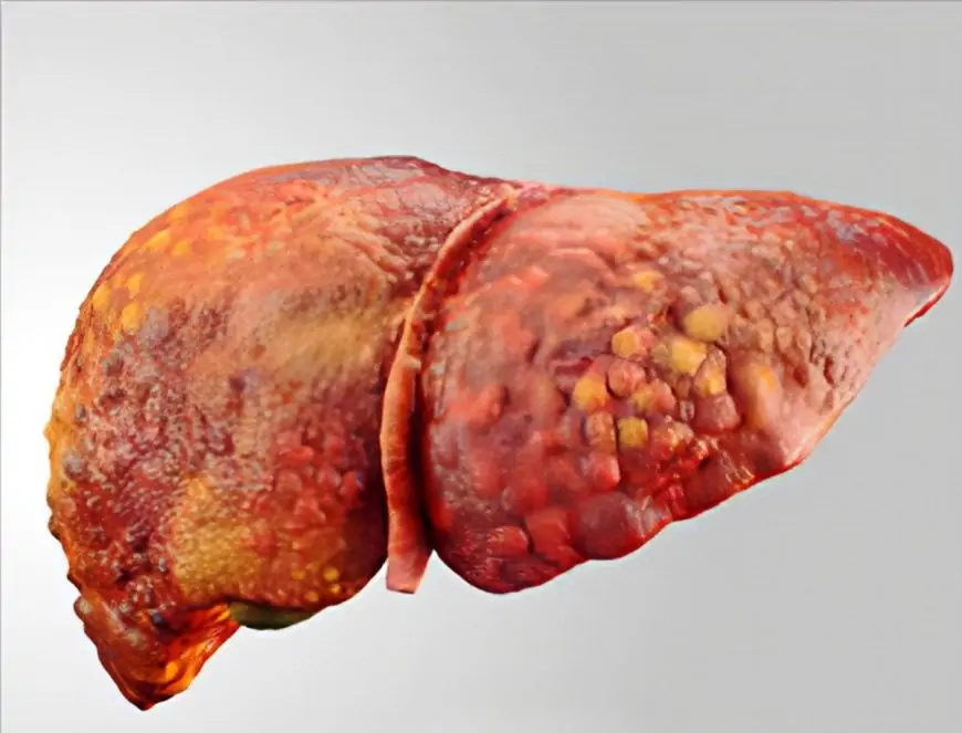 Fatty Liver- A Problem Aggravated By Junk Foods And Stress
