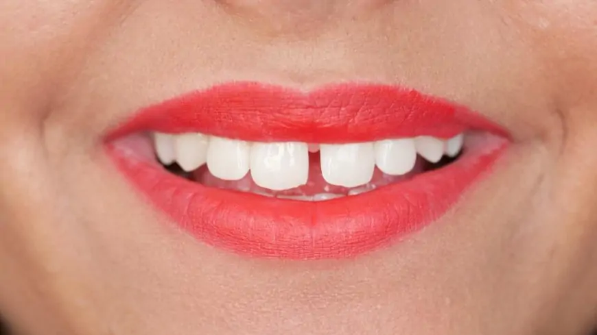 What Is a Teeth Gap and How to Fix It?