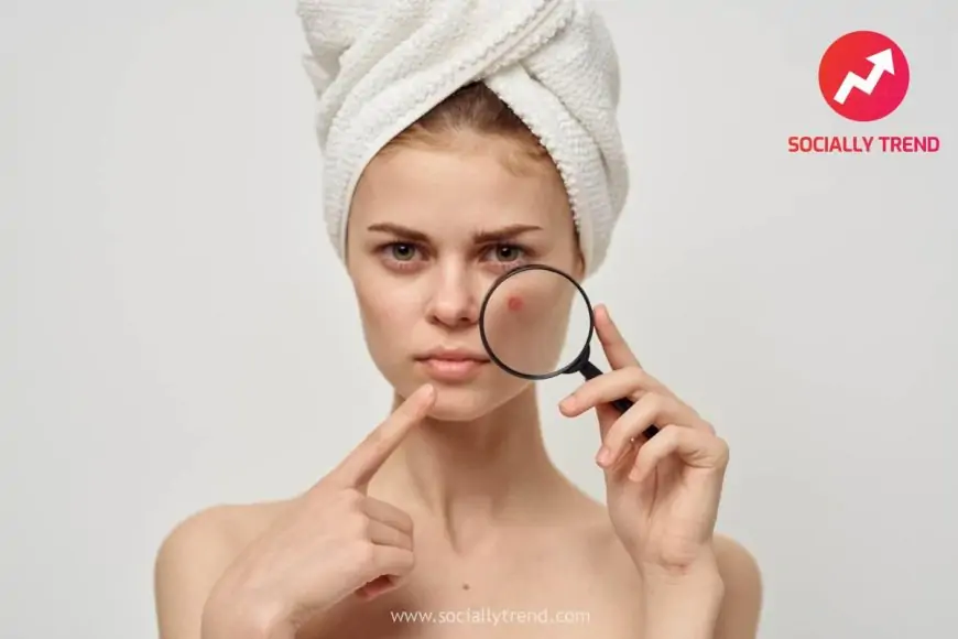 Tired of acne this monsoon, try these home acne treatment tips to rejuvenate your skin