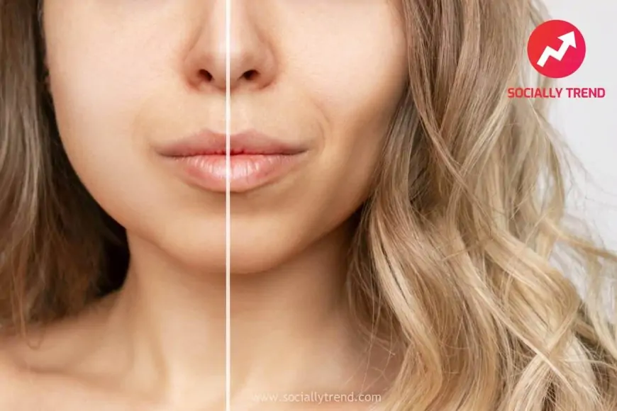 Buccal Fats Elimination: Enhancing Facial Contours