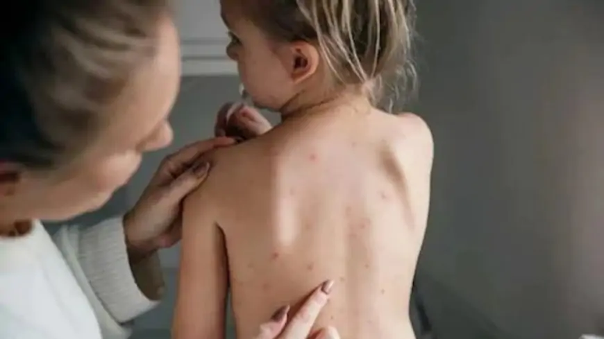 Symptoms Of Chickenpox In Children And A Few Caring Tips