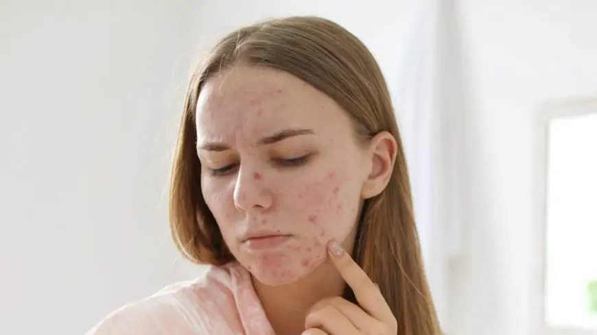 Research Finds How Fat Cells In Skin Help Fight Acne
