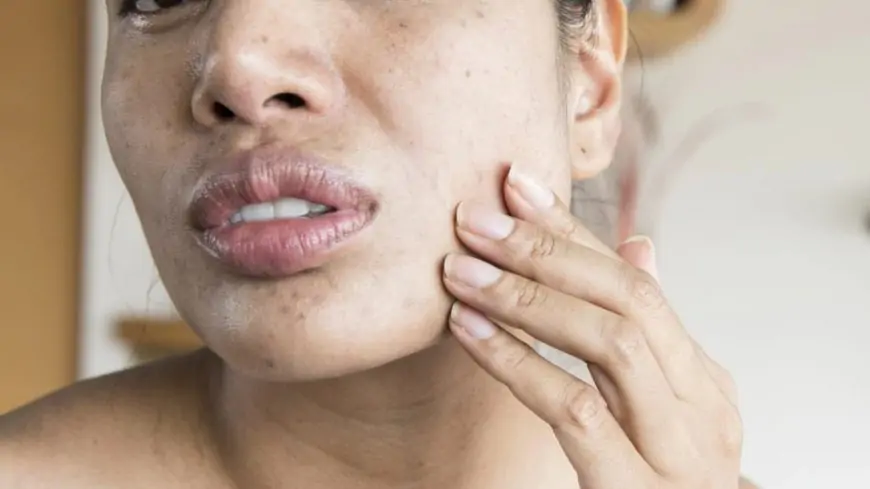 All You Need to Know About the Skin Disease, and How it Affects Mental Health