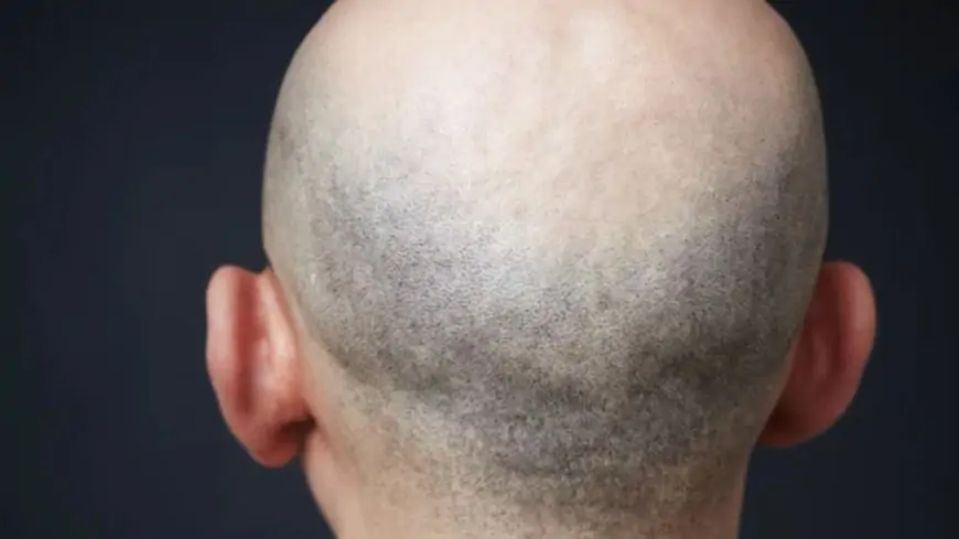 New Study Shows Baldness Can Be Cured; All You Need To Know